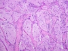 menigioangiomatosis_40x